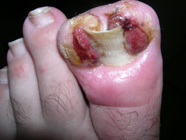 Ingrown Toenail Bad